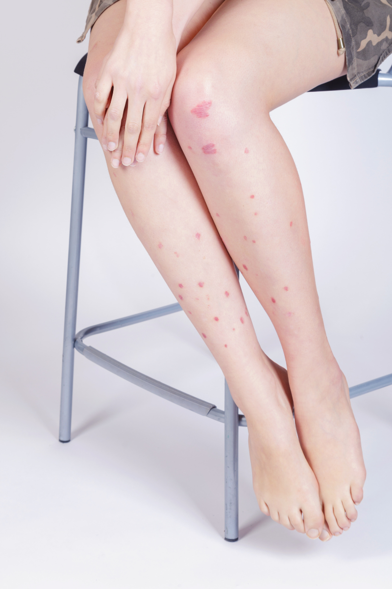 Does Histamine Intolerance Make Your Psoriasis Worse?
